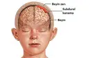 Beyin Zarı Kanaması Belirtileri ve Tedavisi