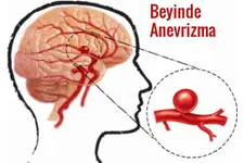 Beyinde Baloncuk Belirtileri ve Tedavisi