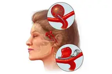 Beyinde Damar Genişlemesi Belirtileri ve Tedavisi