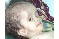 Beyinde Su Toplanması Belirtileri ve Tedavisi