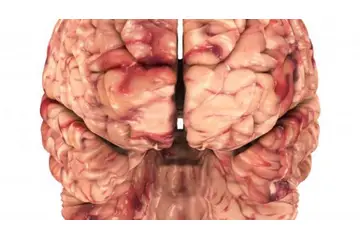 Beyin Sapı İltihabı Belirtileri ve Tedavisi